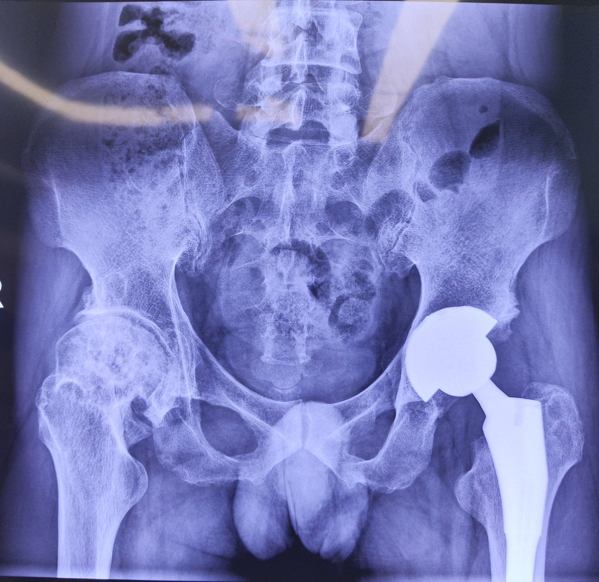 OrthoJianWANG's tweet photo. A 45-year-old male presented with a bilateral external rotation #deformity of the #femur.
During the left hip #replacement, we deliberately reduced the #anteversion of the #acetabular cup and released the external rotator #muscles of the femur.The purpose is to reduce the probability of anterior #dislocation.
With the right hip replacement today, our plan and strategy will be the same as the left.
#MedTwitter #orthotwitter