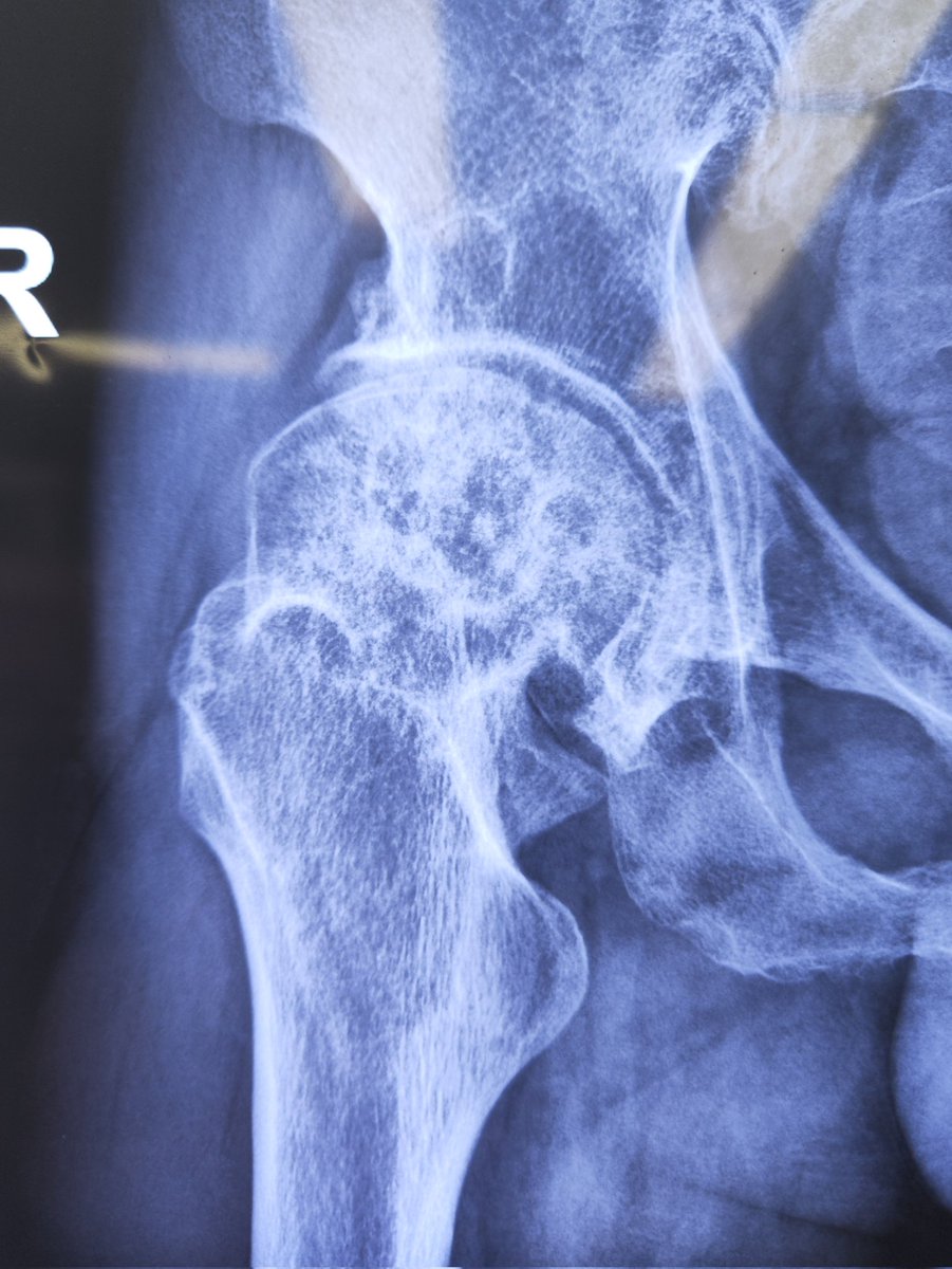 OrthoJianWANG's tweet photo. A 45-year-old male presented with a bilateral external rotation #deformity of the #femur.
During the left hip #replacement, we deliberately reduced the #anteversion of the #acetabular cup and released the external rotator #muscles of the femur.The purpose is to reduce the probability of anterior #dislocation.
With the right hip replacement today, our plan and strategy will be the same as the left.
#MedTwitter #orthotwitter