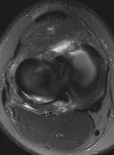 UW_MSKrad's tweet photo. #CaseOfTheWeek ‼️🥳‼️
☢️🩻☠️Case#33☠️🩻☢️
#IncidentalFinding #TornACLReconstruction
➡️➡️📲🦴🩼🧩
#Diagnosis❓❔❓
#FOAMrad #RadEd #OrthoTwitter @ssr_rwg @UWRadRes #MedEd #SportsOrtho @AOSSM_SportsMed https://t.co/G9sFr1UXzw