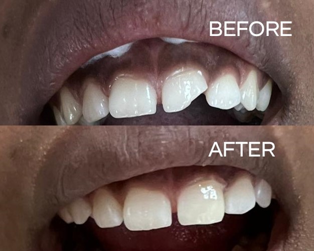 thetooth_dr's tweet photo. The before photo is of our teenage patient with a chipped front tooth. The after photo was achieved with the application of composite bonding filling.
#flossdental #thetoothdr #flossboss #beforeandafter #chippedtooth #compositebonding #oralhygiene #dentistry #trinidadandtobago https://t.co/zxAgCeTjdO