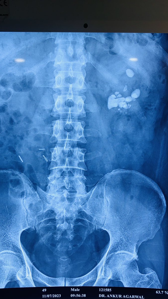 Expert comments please. Supine or prone? One session or two? ECIRS or multiple tracks? Any one for RIRS ? Patient from far off place.