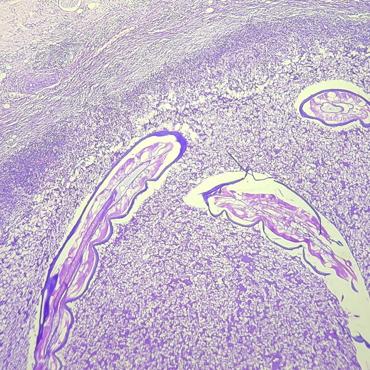 NabZdoc's tweet photo. 25yr, M, neck swelling, Clinical diagnosis- ?Lymphoma. https://t.co/aWmq19r7BG