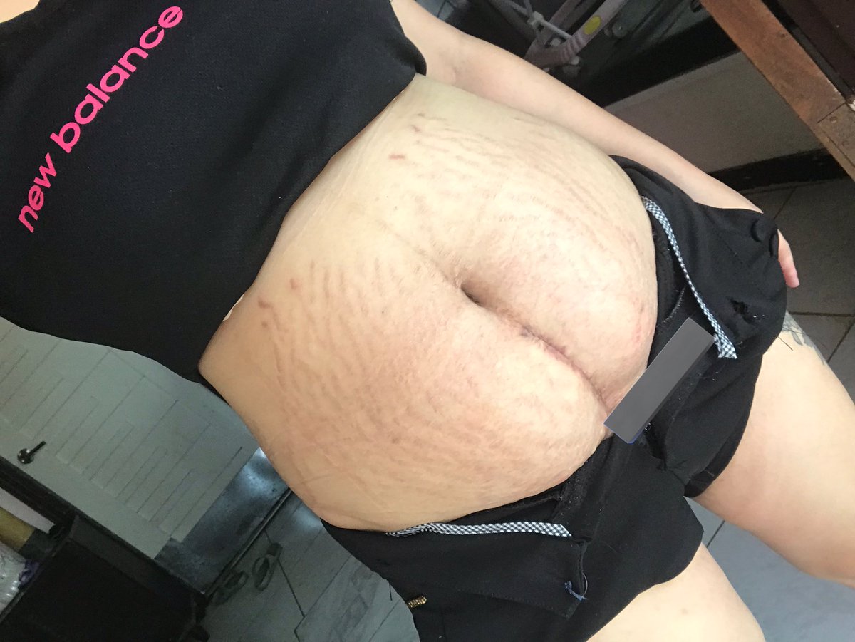 mamiayamifowler's tweet photo. STRETCHMARKS IS ❤️
#bodypositivity
#postpartumbody
#csmom https://t.co/Y6WLkBRVr0