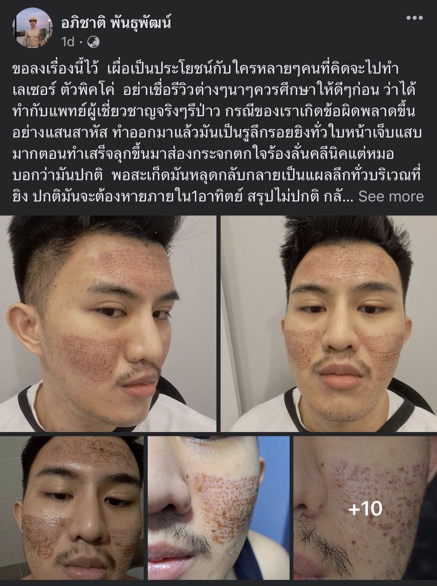 kenglimm's tweet photo. ใครอยากยิง Picosecond laser ควรถามเสมอว่าเครื่องที่ใช้ คือรุ่นอะไร ของบริษัทไหน

แม้จะเป็นเครื่องแท้ได้มาตรฐานอย่าง Discovery Pico, Picosure, Picoway, Enlighten ก็มีรายละเอียดต่างกัน เก่งในการรักษาปัญหาผิวต่างกัน

เช่น บางรุ่น ยิงรักษาหลุมสิว/รูขุมขน ดี บางรุ่นไม่ค่อยเห็นผล https://t.co/Z2DBjoxSov