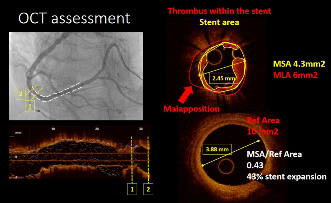 Stent failure management: Discover the optimal use of intracoronary ⭕️ imaging and learn more about the differential role of IVUS and OCT imaging in stent failure in this session replay 📺 @RaberLorenz @DrShereen_ @sbrugaletta pcronline.com/Cases-resource… #CardioTwitter