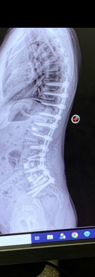 peppypatty64's tweet image. Just took my 2nd tumble since my 10 level spinal fusion June 9th. 😬🤪🫣Luckily had my brace on for both of them. First one was pretty scary as it was only 2 weeks after but this one just hurt my pride, cracked my phone, &amp;amp; scraped my ankle. #coordination #clumsy 😂