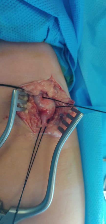 4 y o with previous hospitalization Presented with edema of the right upper limb and engorgement of thoracic and arm veins ,diagnosed as Iatrogenic AVF(IV line), underwent surgical repair 
<a href="/farkomd/">frank arko</a> 
<a href="/VascularForum/">Fórum Vascular</a> 
<a href="/VarenyamVasc/">Dr Himanshu Verma</a>
