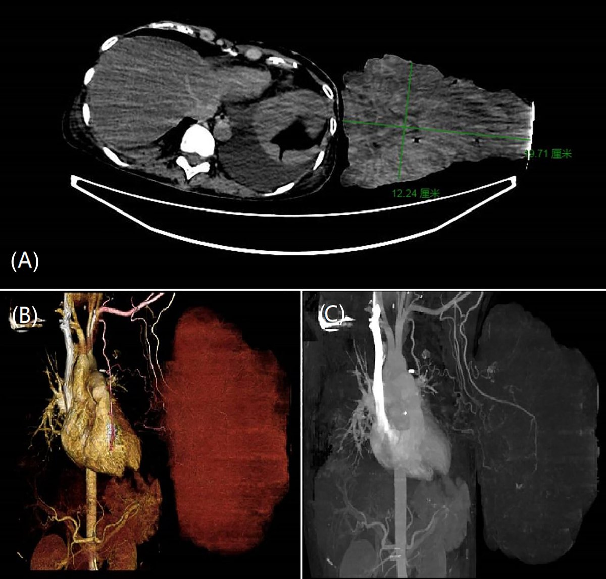 Wang et al. published #CaseStudy of benign #PhyllodesTumor (PT) measuring 30 × 20 × 15 cm3 with #malignant features. Atypical PT accompanied with silent venous thromboembolism. Patient surgically treated, along with anticoagulation therapy.
doi.org/10.1002/cnr2.1…
#CancerReports