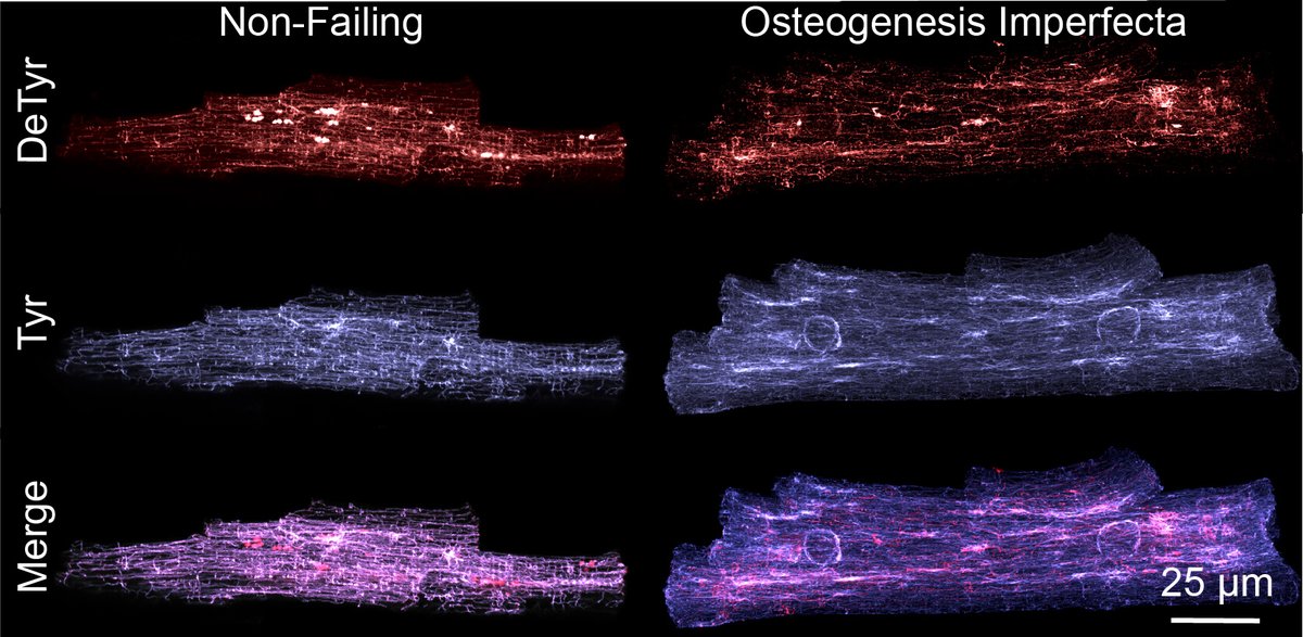 Margulies Lab (@margulieslab) on Twitter photo New paper alert - Adult human cardiomyocyte mechanics in osteogenesis imperfecta
Published in <a href="/ajpheartcirc/">AJP-Heart and Circ</a>, in collaboration with <a href="/MCaporizzo/">Matt Caporizzo</a> <a href="/Prosser_Lab/">Ben Prosser</a> <a href="/AlexiaVite93/">Alexia Vite</a> New paper alert - Adult human cardiomyocyte mechanics in osteogenesis imperfecta
Published in <a href="/ajpheartcirc/">AJP-Heart and Circ</a>, in collaboration with <a href="/MCaporizzo/">Matt Caporizzo</a> <a href="/Prosser_Lab/">Ben Prosser</a> <a href="/AlexiaVite93/">Alexia Vite</a>