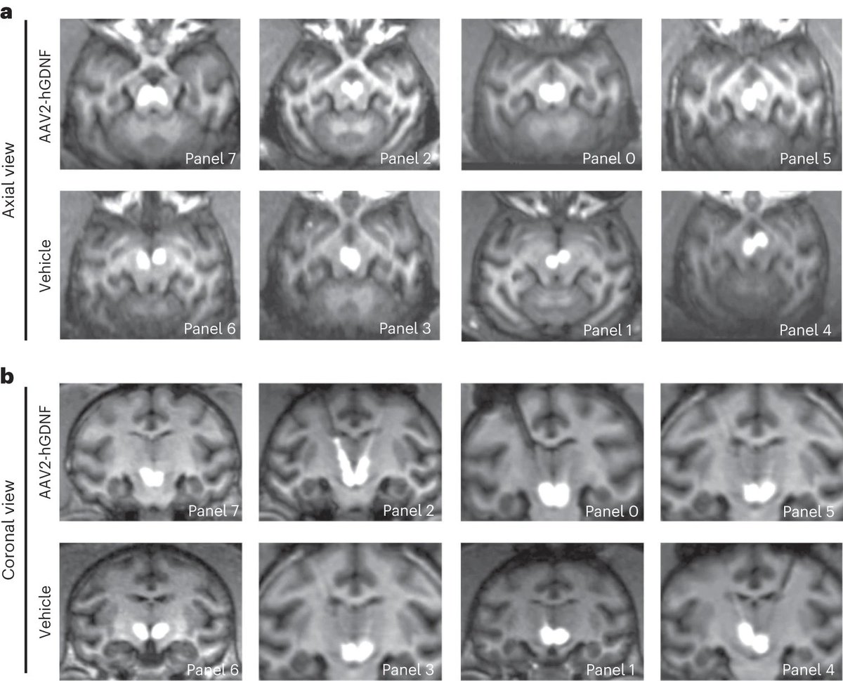 Gene therapy using neurotrophic factor shows promise in reducing alcohol intake & craving. Monkeys drank heavily for 12 weeks before gene therapy, which increased the expression of GDNF in brain regions involved in alcohol reward & motivation. 🍺🐒 nature.com/articles/s4159…