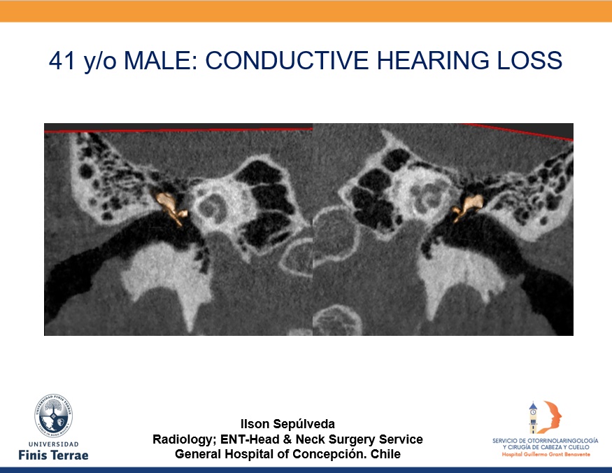 iasepulveda's tweet photo. Just to share..illustrative case..a little preview of my next conference at the XIII Alarid Congress next August 18th..see you there!!!!! #conebeamct #hnrad
@drjengillespie
@SalmanQureshiDr
@jussihirvonen
@drSurjthVattoth
@MohitAgNeurorad
@entradiology
@darkahadnadjevs https://t.co/0WhHU3DgdD