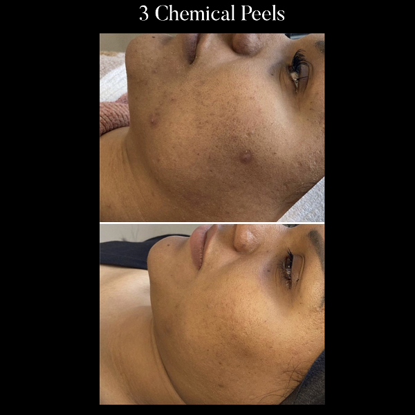 foreverbyash's tweet photo. We have chemical peels to suit any type of skin concern; whether it’s removing wrinkles and sunspots, clarifying acne-prone skin, reducing pore size, or even helping with uneven pigmentation. Visit our website for more information!

#ChemicalPeel https://t.co/Tqh0sZwtBt https://t.co/gUHEsJY98N