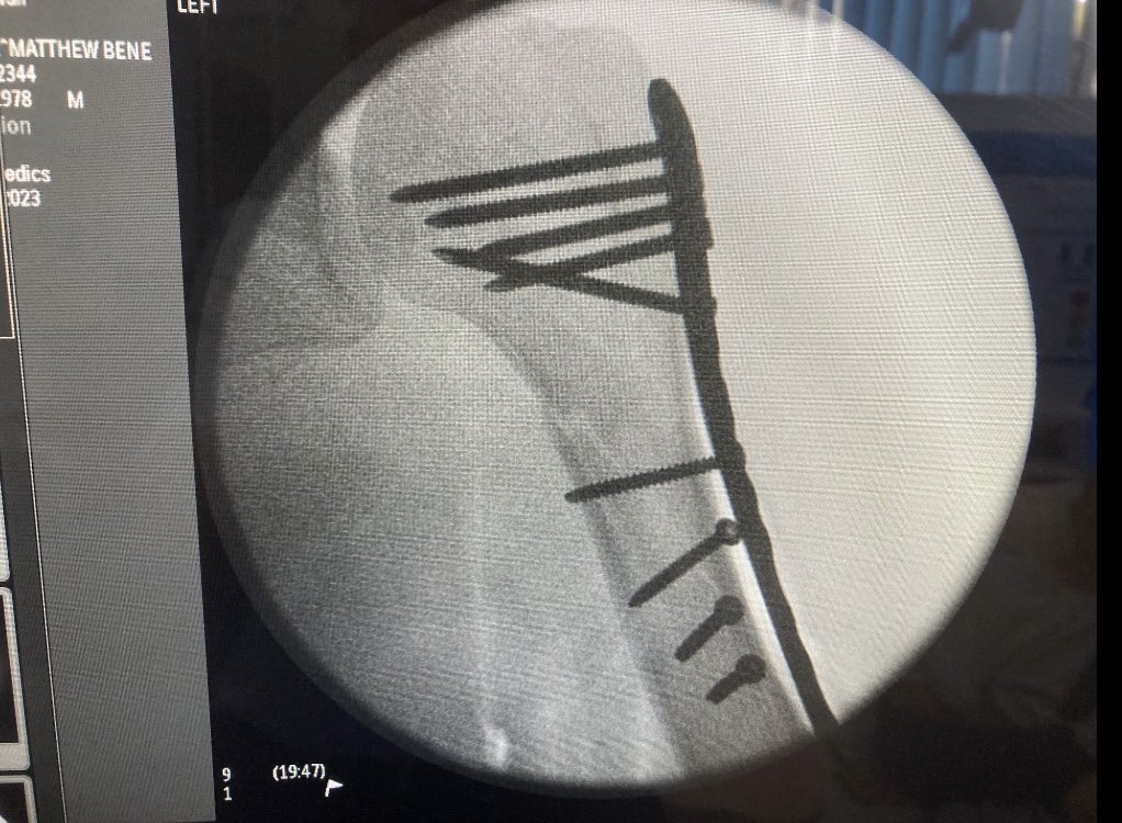 Mathos78's tweet image. On the mend second day of the holiday and i have broken my collarbone and top of my arm. Keep smiling 🙂

UPDATE Matt has a spiral fracture of his left humerus ￼and a dislocated shoulder had surgery yesterday to put screws and metal work in.