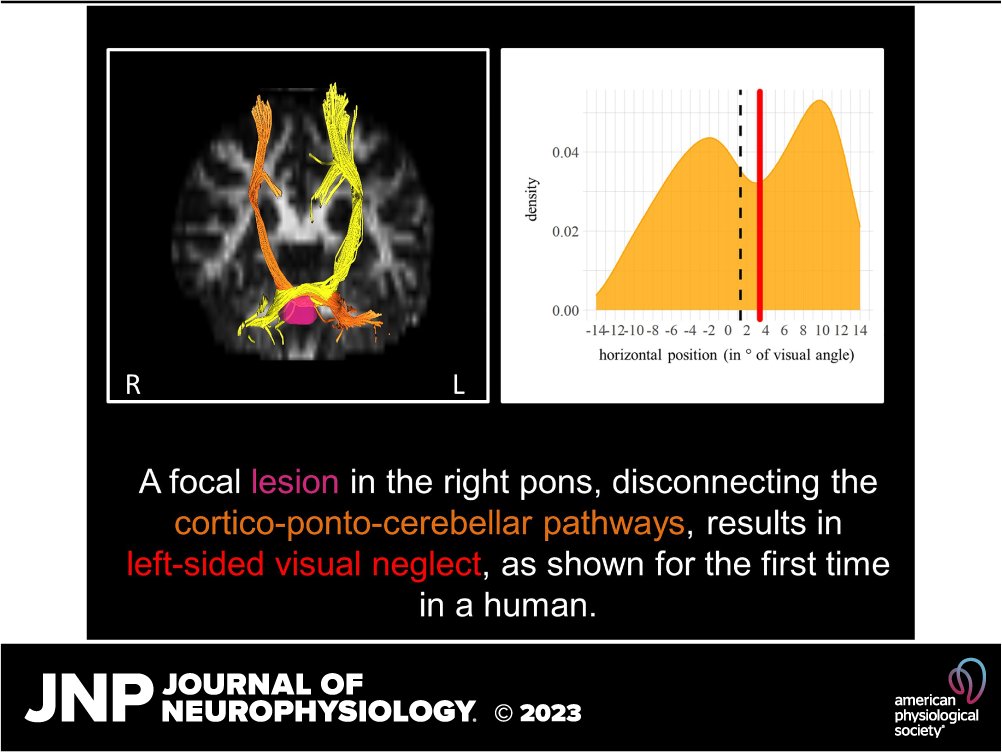 JNeurophysiol's tweet image. 🧠A case study of left visual neglect after right pontine lesion: pathophysiological evidence for the infratentorial involvement in human visual attention by Dario Cazzoli et al.
👉 ow.ly/oGq850PbVwp
#VisuospatialAttention #Pathophysiology #DiffusionTensorImaging