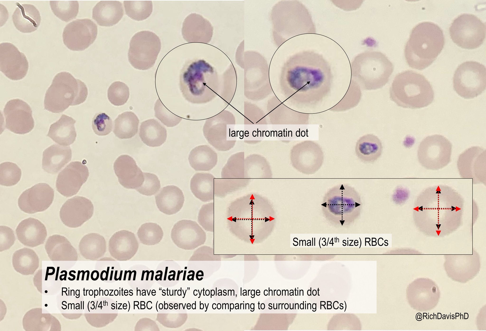 How to identify the type of malaria on a blood smear | Medmastery
