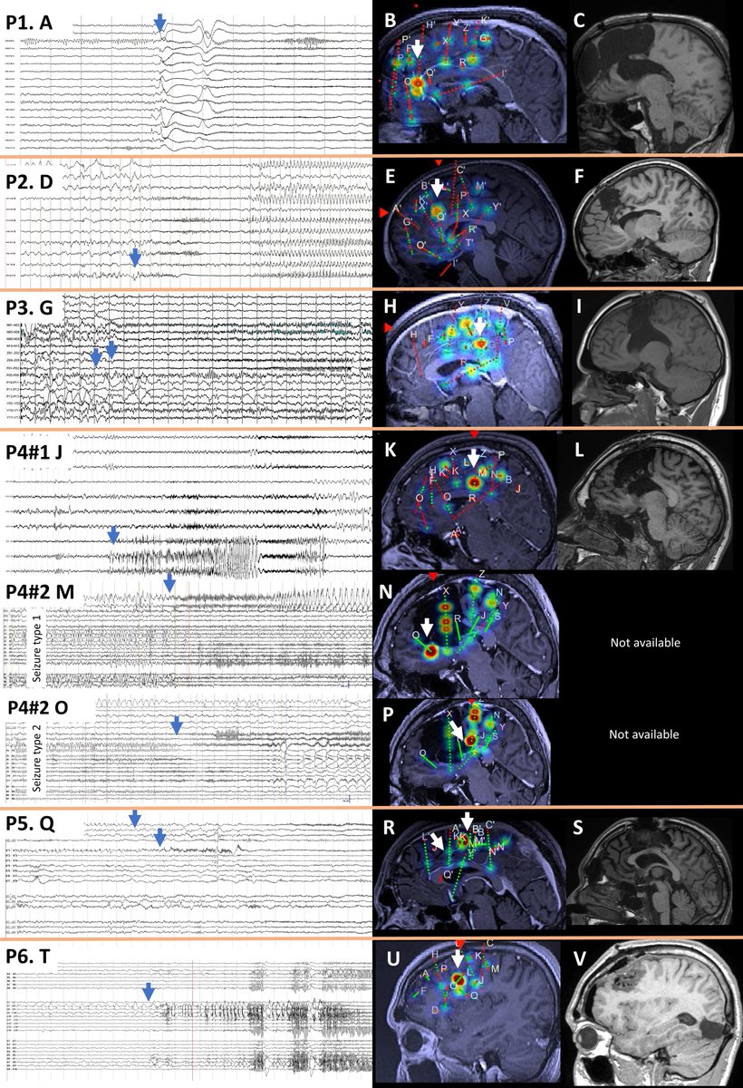 EpilepsiaOpen's tweet photo. Organization of the epileptogenic zone and signal analysis at #seizure onset in patients with drug-resistant #epilepsy due to focal cortical dysplasia with #mTOR pathway gene mutations – an #SEEG study
https://t.co/RUdZORIdtU

#epilepsysurgery @IlaeWeb @WileyNeuro #ILAE https://t.co/N2MOrXPutk