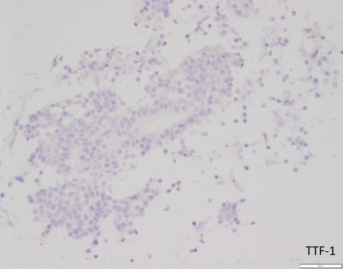 UpstateCytology's tweet photo. Great job, everyone! This is a carcinoid tumor, favor typical. Here are some more photos. #PathTwitter #cytopath #cytopathology https://t.co/L8kesOuKZG