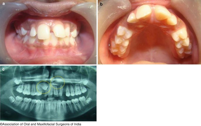 What is the IOTN DHC score for this patient?