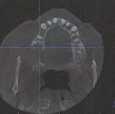 70s M maxillary mass. Basaloid odontogenic tumor with features of ameloblastoma showing malig transformation. More pics below #PathTwitter #PathX #HeadAndNeckPath