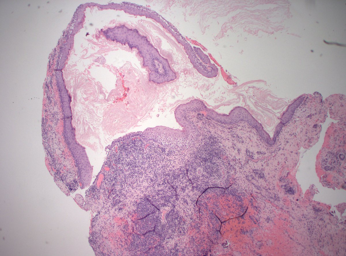 Now THAT'S a cholesteatoma. #PathTwitter #PathX #headandneckpath