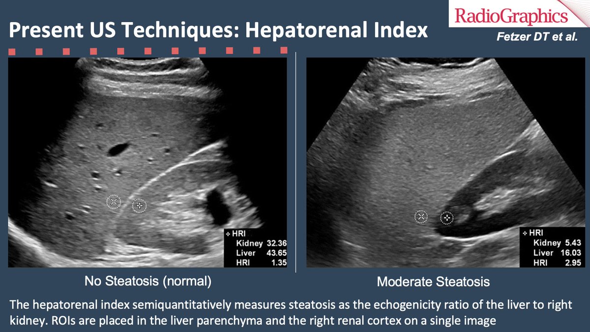 Various hepatorenal index cutoffs for the presence of steatosis have been published, ranging from 1.24 to 2.2
#RGphx #GIRad #USRad
@Radiographics @RSNA 
5/8