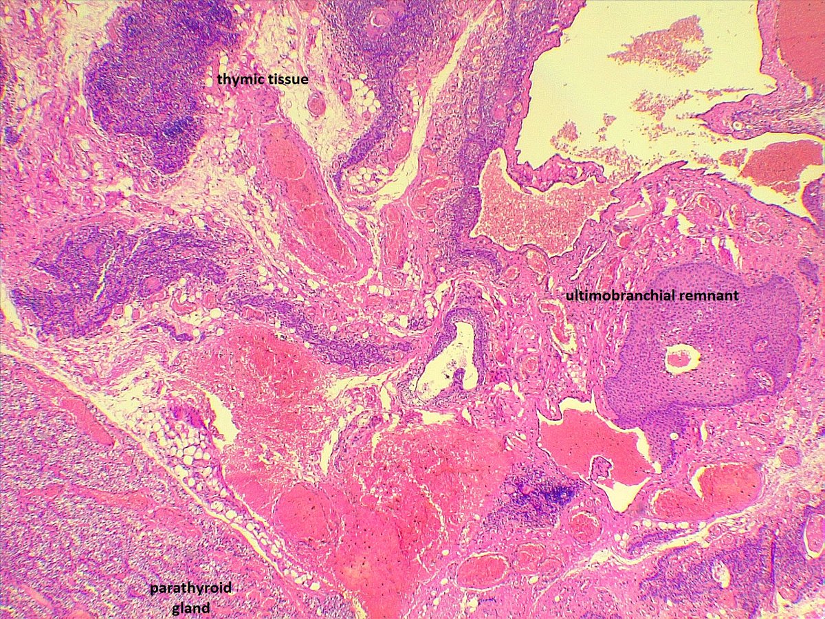 Thyroid containing thymus, thymus containing parathyroid and ultimobranchial body #PathTwitter