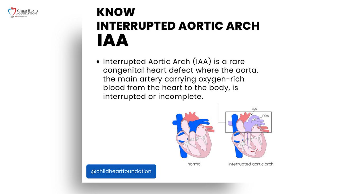 🚩Let's dive into Interrupted Aortic Arch (IAA), a rare congenital heart defect that comes in different types - Type A, B, and C. Join us in understanding the intricacies of IAA and its impact on young hearts. 💙🫀 #IAAawareness #CHDsupport #ChildHeartFoundation #HeartDefects