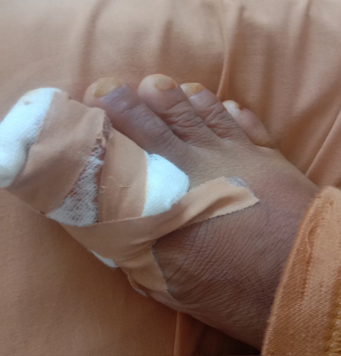 megandikka's tweet photo. Stop orek2 ujung kuku! Bersihkan dan gunting seperlunya kalau ga ingin bernanah n operasi dicabut😔 (baiknya rendam air hangat dulu sblm gunting kuku) https://t.co/eEBLgWRwjM