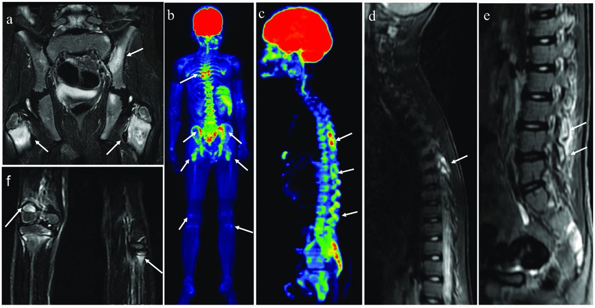 Insights into Imaging (@insightsimaging) on Twitter photo Educational Review: #Chronic nonbacterial osteomyelitis - the role of whole-body #MRI. (Marcelo Astolfi Caetano Nico et al., <a href="/JulioBGuimaraes/">Julio B. Guimaraes, MD, PhD</a>)
#InsightsIntoImaging
🔗 buff.ly/3YxUF5R Educational Review: #Chronic nonbacterial osteomyelitis - the role of whole-body #MRI. (Marcelo Astolfi Caetano Nico et al., <a href="/JulioBGuimaraes/">Julio B. Guimaraes, MD, PhD</a>)
#InsightsIntoImaging
🔗 buff.ly/3YxUF5R