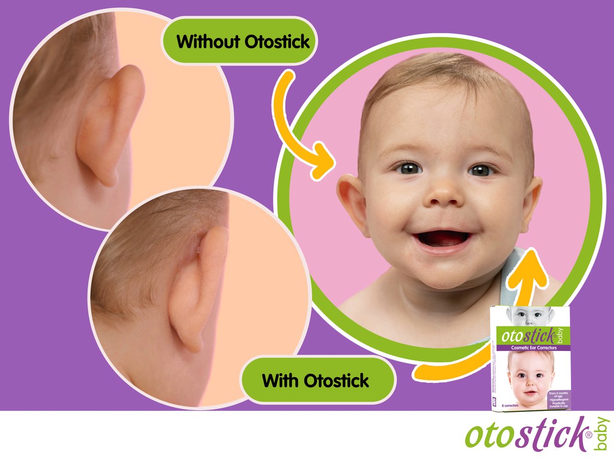 Did you know that ear protrusion can start at a very young age?
Otostick Baby is a corrector made from silicon and medical adhesives for protruding ears.

otostick.com

#otostick #otostickbaby #earcorrectors #nosurgery #cosmetics #pinnedears #earpinning #babies #ears