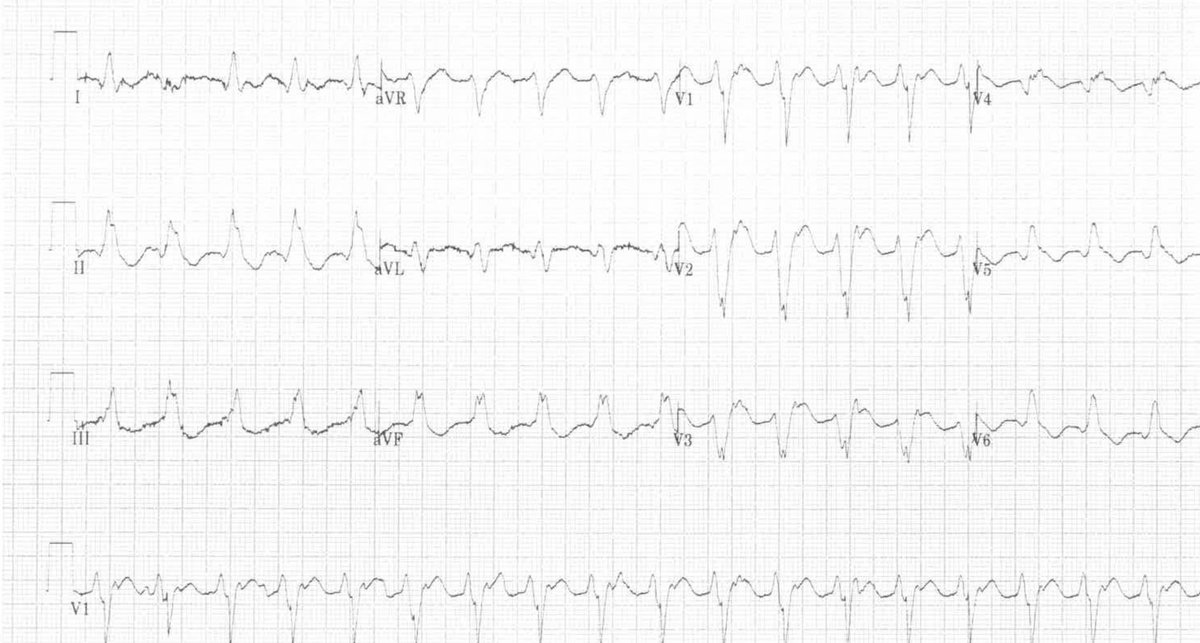 dhirendra208's tweet photo. For learning. 75 yrs HOCM, severe LVSD,  on CRT-D, presented with sudden breathlessness. What is the presenting rhythm? @UlhasDr @smithECGBlog https://t.co/k66t9ovvae