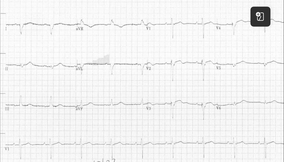 dhirendra208's tweet photo. For learning. 75 yrs HOCM, severe LVSD,  on CRT-D, presented with sudden breathlessness. What is the presenting rhythm? @UlhasDr @smithECGBlog https://t.co/k66t9ovvae