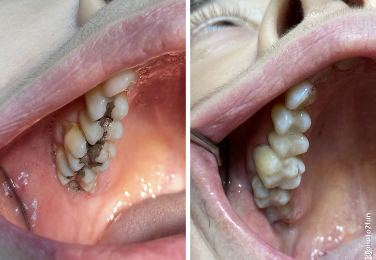 PratoHector's tweet photo. ¿amalgamas por resinas?
Los materiales de resina como el ionomero de vidrio, ya que no están formados de metal, y por tanto no se oxidan, ni corroen. Este material libera iones de flúor al tejido dental, lo que va a prevenir en un alto porcentaje la aparición de una caries. https://t.co/xwj8fMl2ii