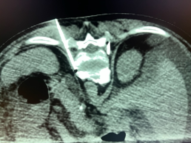Splanchnic plexus block and follow-up #cryoablation for #pain related to peritoneal carcinomatosis. >50% pain reduction and increased QOL.  We can make a difference! <a href="/bostonsci/">Boston Scientific</a> <a href="/jdprologo/">J. David Prologo, MD, FSIR, ABOM-D</a> <a href="/Gina_Landinez_/">Gina Landinez</a> <a href="/AlanAlperMD/">Alan Alper Sag, MD, FSIR</a> <a href="/TheRealDoctorOs/">Osman Ahmed</a> <a href="/SIRspecialists/">Society of Interventional Radiology</a> <a href="/womenirads/">WomeninIR</a>, <a href="/memorialhermann/">Memorial Hermann</a>