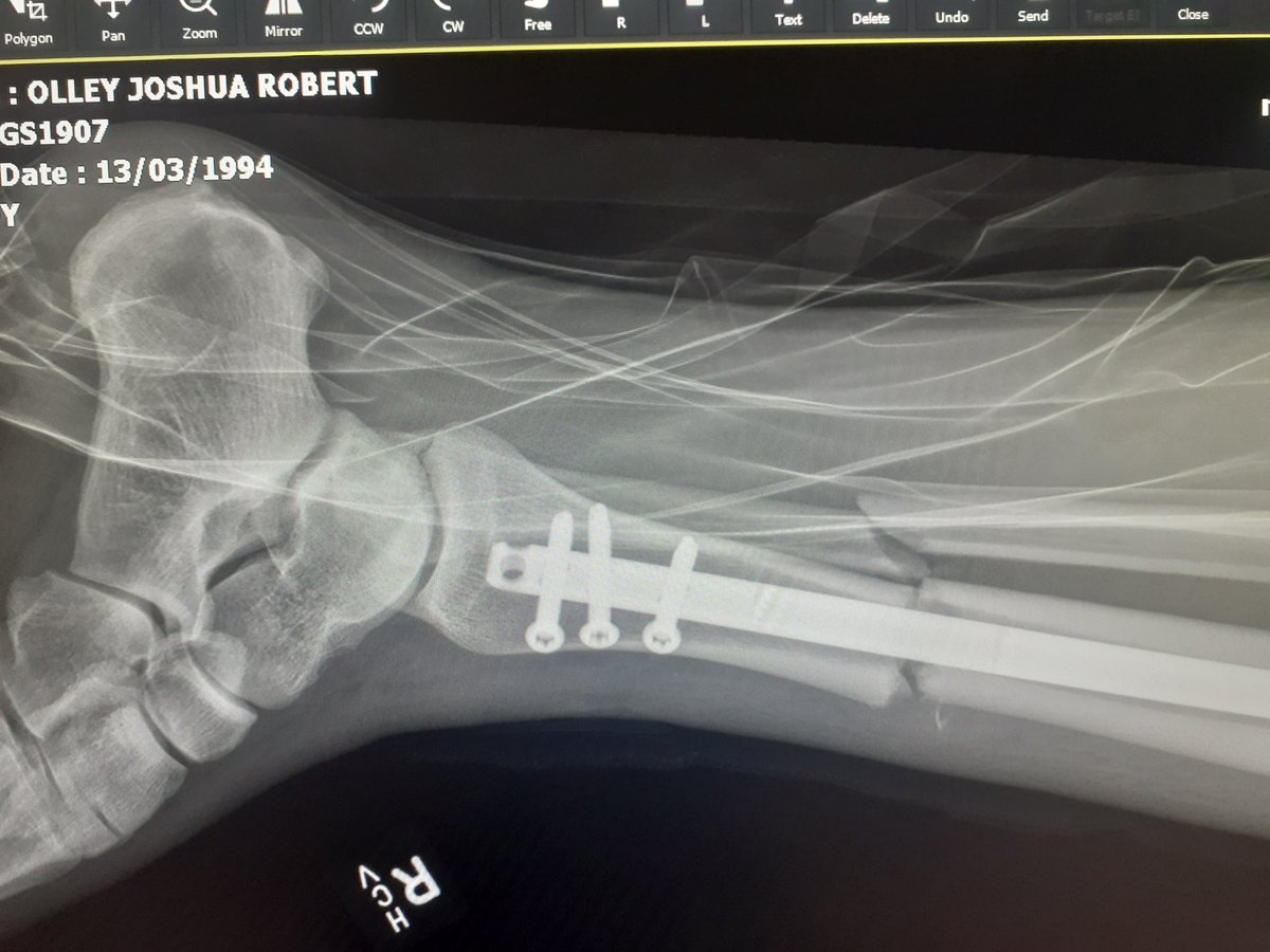 Shadyapprentice's tweet photo. @JRsBBQ Damn J.R. you on a long road to recovery too, hang in there bud. You're not alone. 
Less than two weeks ago I had an unfortunate tackle during soccer, rough way to end the season. https://t.co/tupPMVj0SH