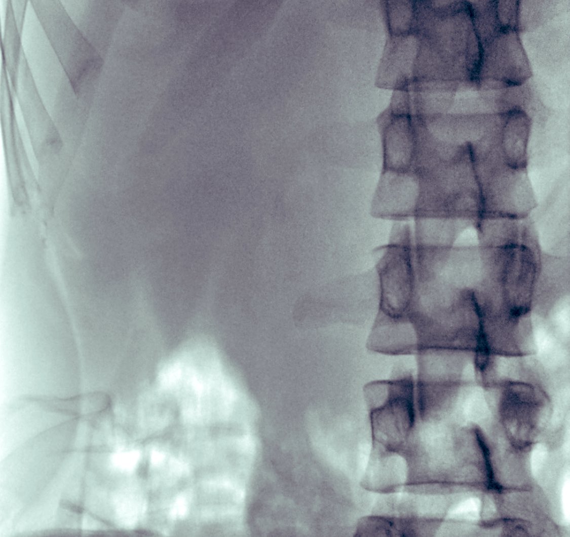 Kemal Sarıca (@drkemalsarica) on Twitter photo To see "no stone" just at the end of a truly "non-invasive"procedure is a great happiness for the urologist and chance for the patient. 13 mm RP stone has been pulverized with SWL in 35 min with "Modulith SLK inline lithotriptor".SWL is still alive and still active.<a href="/storzmedical/">STORZ MEDICAL</a> To see "no stone" just at the end of a truly "non-invasive"procedure is a great happiness for the urologist and chance for the patient. 13 mm RP stone has been pulverized with SWL in 35 min with "Modulith SLK inline lithotriptor".SWL is still alive and still active.<a href="/storzmedical/">STORZ MEDICAL</a>