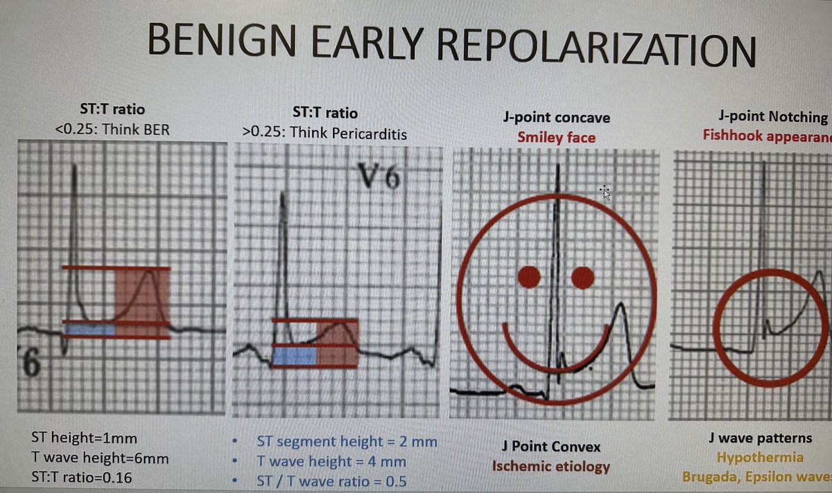 BER: Final frontier.
Stable, STE (concave upwards, precordial) in young males, may disappear with older age, more prominent at slower heart rates. T waves prominent with resultant low ST:T ratio.