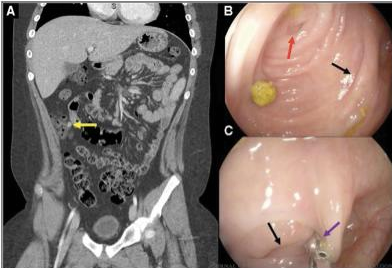 JPGNonline's tweet image. 12 yo boy with progressively worsening RLQ pain.  CT showing an 11mm structure near the cecum. Colonoscopy shows a cecal diverticula.

What is the next best step?

Answer and learn more 👉 bit.ly/3htf9YP?utm_so…

#imageofthemonth #quickpoll