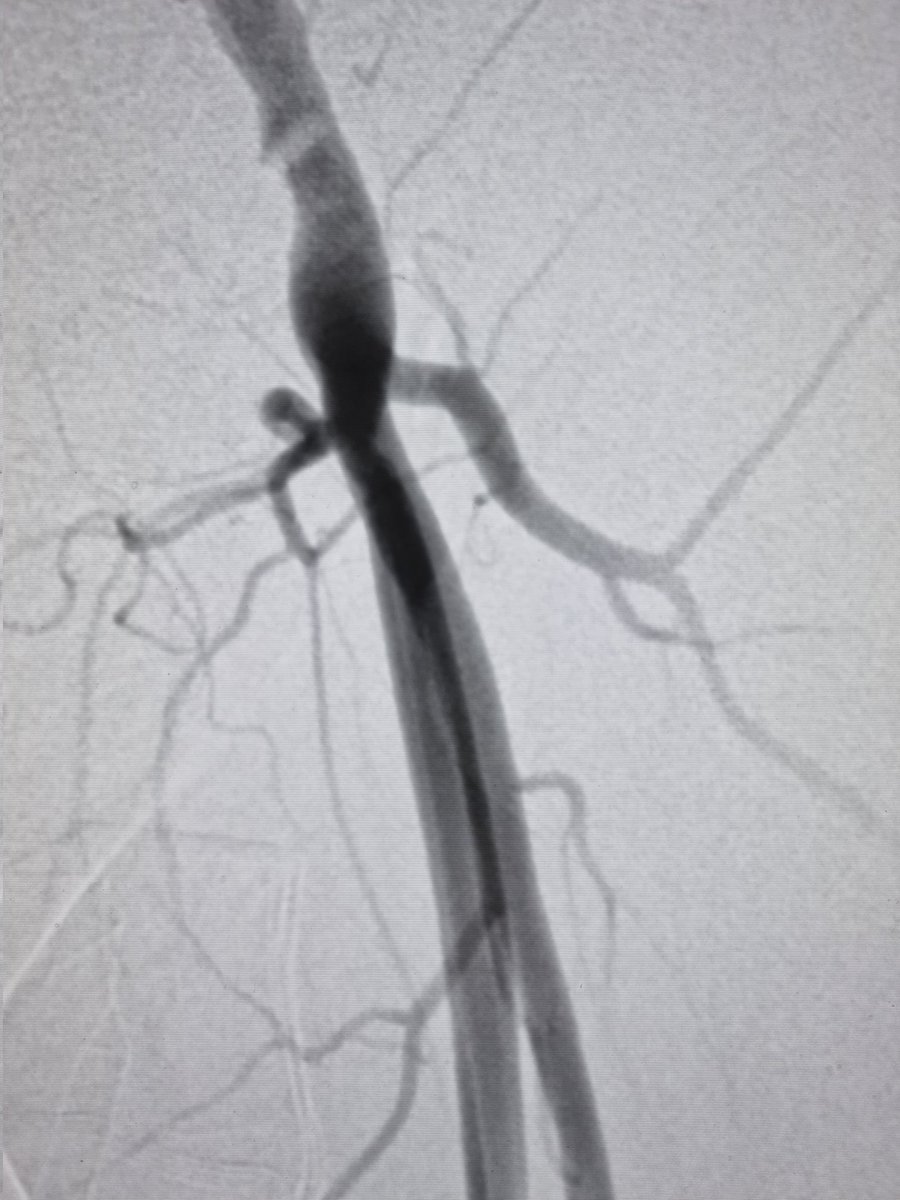 Percutaneous decannulation of ECMO should be the way forward. Open repair is sig. associated with wound infection. We usually perform US guided postclosure with #Abbott #Proglide for both the large bore cannula and the DPC. I always park a crossover sheath as safety. #ECMO #ELSO