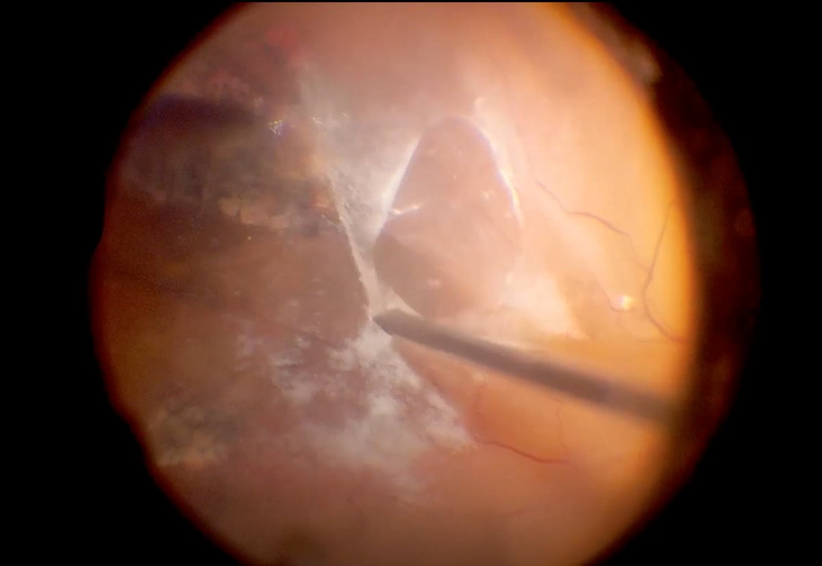 In this Retinaws surgical video, Ehab El Rayes, MD, shares a case of myopic #retinaldetachment, and the panel discusses common complications such as an adherent hyaloid. bit.ly/3QYIbmj