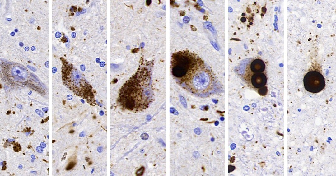 Department of Laboratory Medicine & Pathobiology (@uoft_lmp) on Twitter photo This week’s 2023 LMP Art Competition feature, “Life of a Lewy Body,” is from LMP PhD candidate Ain Kim.
This image was captured in <a href="/GGKovacsBrain/">Gabor G. Kovacs MD PhD FRCPC</a> lab at <a href="/tanzuoft/">Tanz Centre at University of Toronto</a>
#uoft #uoftlmp #uoftmedicine #labmedicine #scienceart #pathology #lewybody #dementia #alzheimers This week’s 2023 LMP Art Competition feature, “Life of a Lewy Body,” is from LMP PhD candidate Ain Kim.
This image was captured in <a href="/GGKovacsBrain/">Gabor G. Kovacs MD PhD FRCPC</a> lab at <a href="/tanzuoft/">Tanz Centre at University of Toronto</a>
#uoft #uoftlmp #uoftmedicine #labmedicine #scienceart #pathology #lewybody #dementia #alzheimers