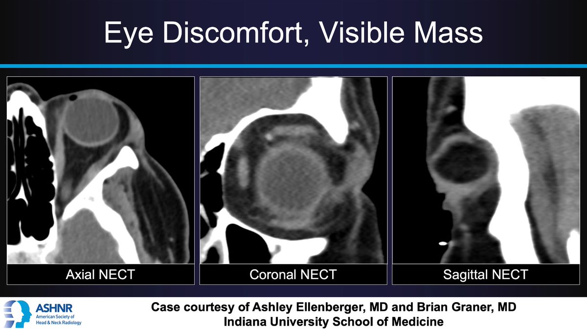 #ASHNRCOTW #224: Eye discomfort, visible mass. Dx? Thx Drs. Ellenberger & Graner @IURadiology 4 case! #ASHNR23 Answer w/ appropriate GIF only -- stay professional & don't spoil it! @AshokSrini15 @callyrobs @DShatzkes @CDP_Rad @rhwiggins @nakoontz @cmtomblinson @ESHNRSociety