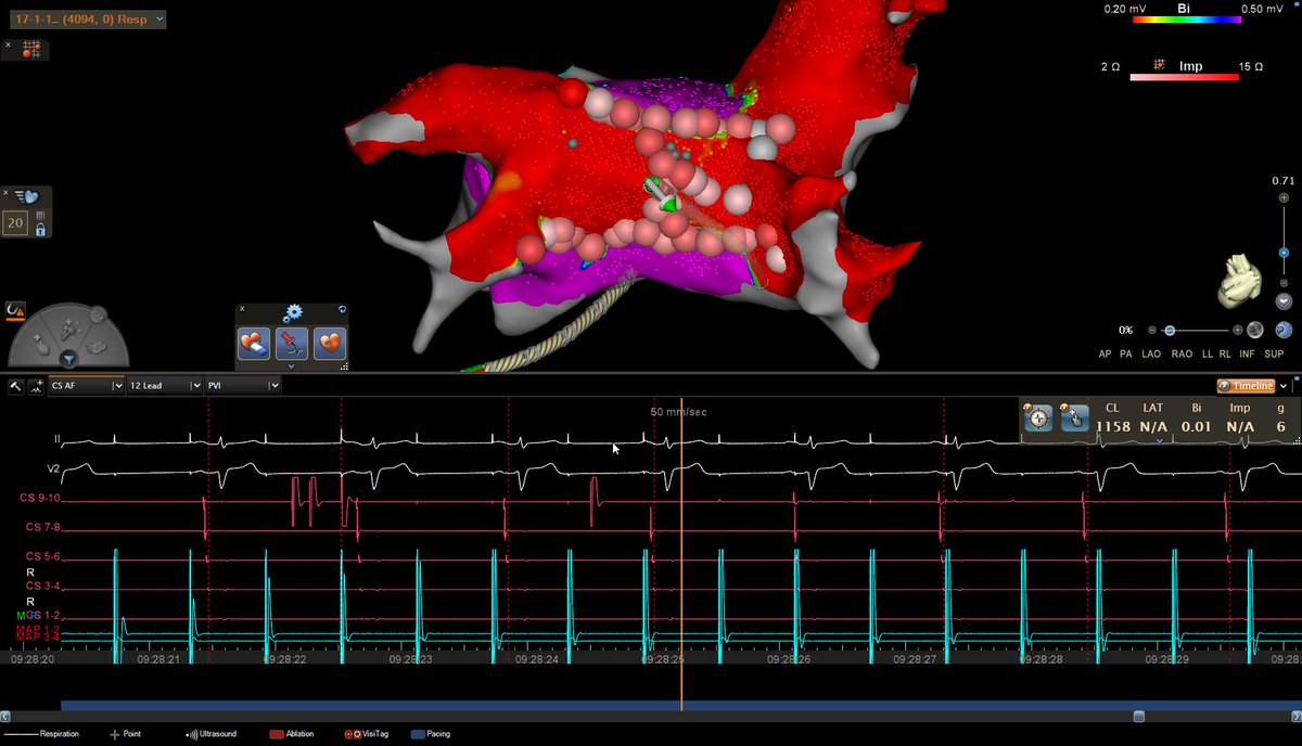 SharafGhaith's tweet photo. Exciting to see case by @AnwarChahal today! 
Redo AF and flutter ablation with ZERO fluro guided by preprocedural MRI, with ICE and Carto!
@EOG_MD @BSCCardiology #epeeps
@ChrisSpellmanEP
@BiosenseWebster https://t.co/eo1MKkDDP9