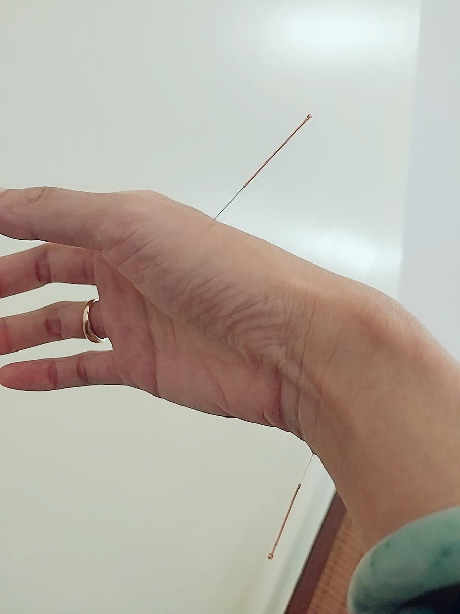 PunnieVIIIXVIII's tweet photo. #Acupuncture #CuppingTherapy #GdHealth #Relaxed https://t.co/PnpasWKWm8