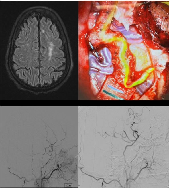 Rizwan Tahir (@riztahirmd) on Twitter photo 6 mo. F/U on my first bypass as an attending for Moyamoya. Nice to see STA caliber increased in just 6 mo. Hopefully a radiographic indicator of demand? Proud to have been trained by 2 of the best <a href="/DrFadyCharbel/">Dr. Fady Charbel</a> and Dr. Sepideh Amin-Hanjani! <a href="/MedStarWHC/">MedStar Washington</a> <a href="/MGUHNeurosurg/">Georgetown/WHC Neurosurgery</a> 6 mo. F/U on my first bypass as an attending for Moyamoya. Nice to see STA caliber increased in just 6 mo. Hopefully a radiographic indicator of demand? Proud to have been trained by 2 of the best <a href="/DrFadyCharbel/">Dr. Fady Charbel</a> and Dr. Sepideh Amin-Hanjani! <a href="/MedStarWHC/">MedStar Washington</a> <a href="/MGUHNeurosurg/">Georgetown/WHC Neurosurgery</a>