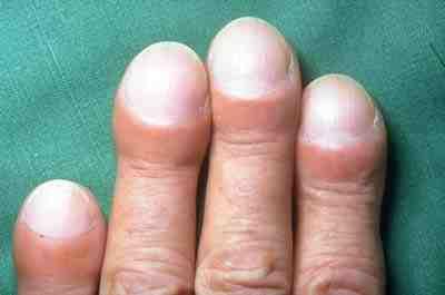 nursingahead's tweet photo. التليف الرئوي Idiopathic lung fibrosis: 
هو تلف وندوب وصلابة في أنسجة الرئة، مما يزيد من صعوبة أداء الرئة لوظيفتها الطبيعية، وبالتالي عدم حصول الجسم على حاجته من الأكسجين، مما يؤدي فشل في الجهاز التنفسي، وفشل القلب ومضاعفات أخرى.

من اعراض المرض : 
Clubbing fingers or clubbing toes 
زيادة في عرض ودوران اصابع اليدين او الارجل .