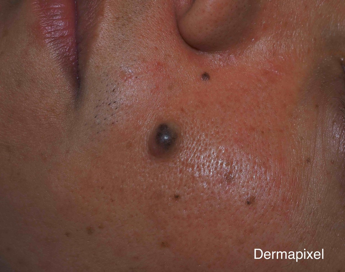 rosataberner's tweet image. Foliculitis subnévica: un problema frecuente (y sin mayor importancia).
dermapixel.com/2023/08/folicu…
No siempre que un lunar pica o duele significa algo malo.
#dermatología