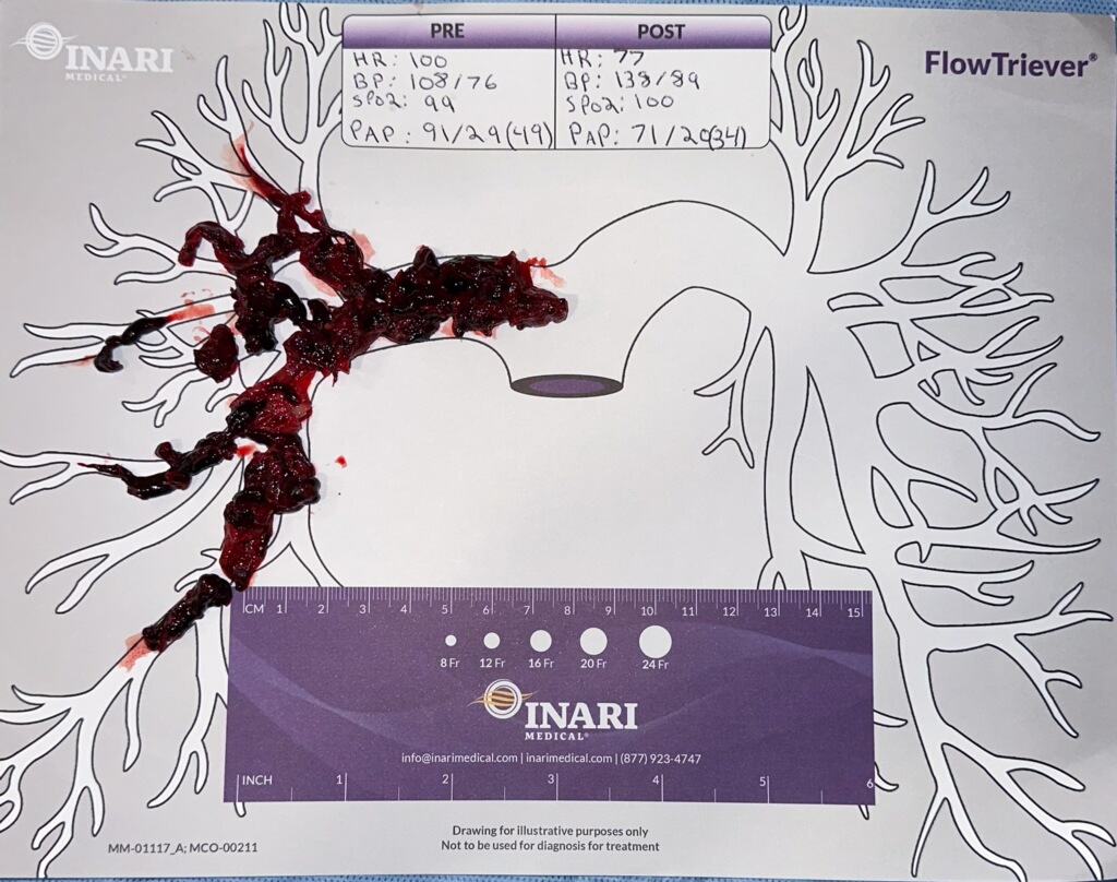 Amit Ramjit (@amitramjitmd) on Twitter photo Another big haul using <a href="/InariMedical/">Inari, now part of Stryker</a> T24 FlowTriever w/large drop in PA pressure <a href="/PERTConsortium/">The PERT Consortium®</a> <a href="/PertPoz/">PERT-POZ</a> <a href="/MedDeviceMatt/">MP</a> <a href="/SIRspecialists/">Society of Interventional Radiology</a> <a href="/SIR_ECS/">SIR ECS</a> <a href="/NYSRSociety/">NYSRS, Inc</a> <a href="/IrNyrs/">NYRS IR</a> Another big haul using <a href="/InariMedical/">Inari, now part of Stryker</a> T24 FlowTriever w/large drop in PA pressure <a href="/PERTConsortium/">The PERT Consortium®</a> <a href="/PertPoz/">PERT-POZ</a> <a href="/MedDeviceMatt/">MP</a> <a href="/SIRspecialists/">Society of Interventional Radiology</a> <a href="/SIR_ECS/">SIR ECS</a> <a href="/NYSRSociety/">NYSRS, Inc</a> <a href="/IrNyrs/">NYRS IR</a>