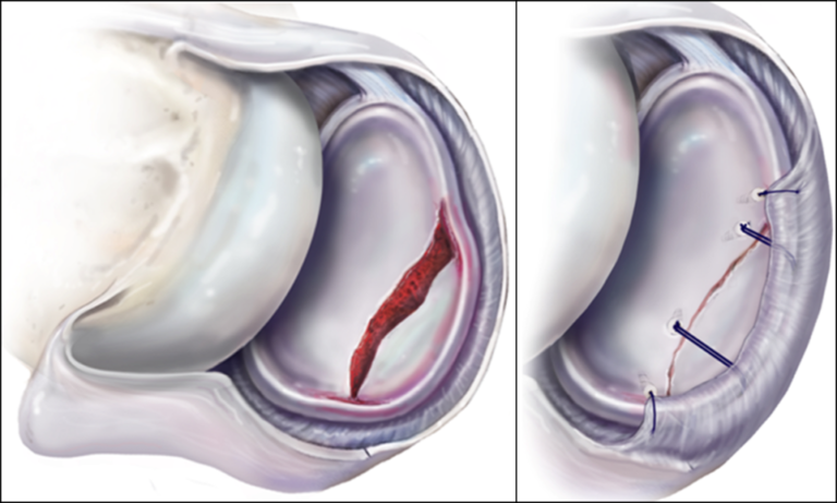 drchrisahmad's tweet image. Spotlight: Bony Bankart Lesions
Occur when the #humerus is compressed against the #labrum as happens during anterior shoulder #dislocations or #subluxations.. There is detachment of the anteroinferior labrum from the underlying #glenoid ..
Learn More:
drahmadsportsmedicine.com/expertise/shou…✅