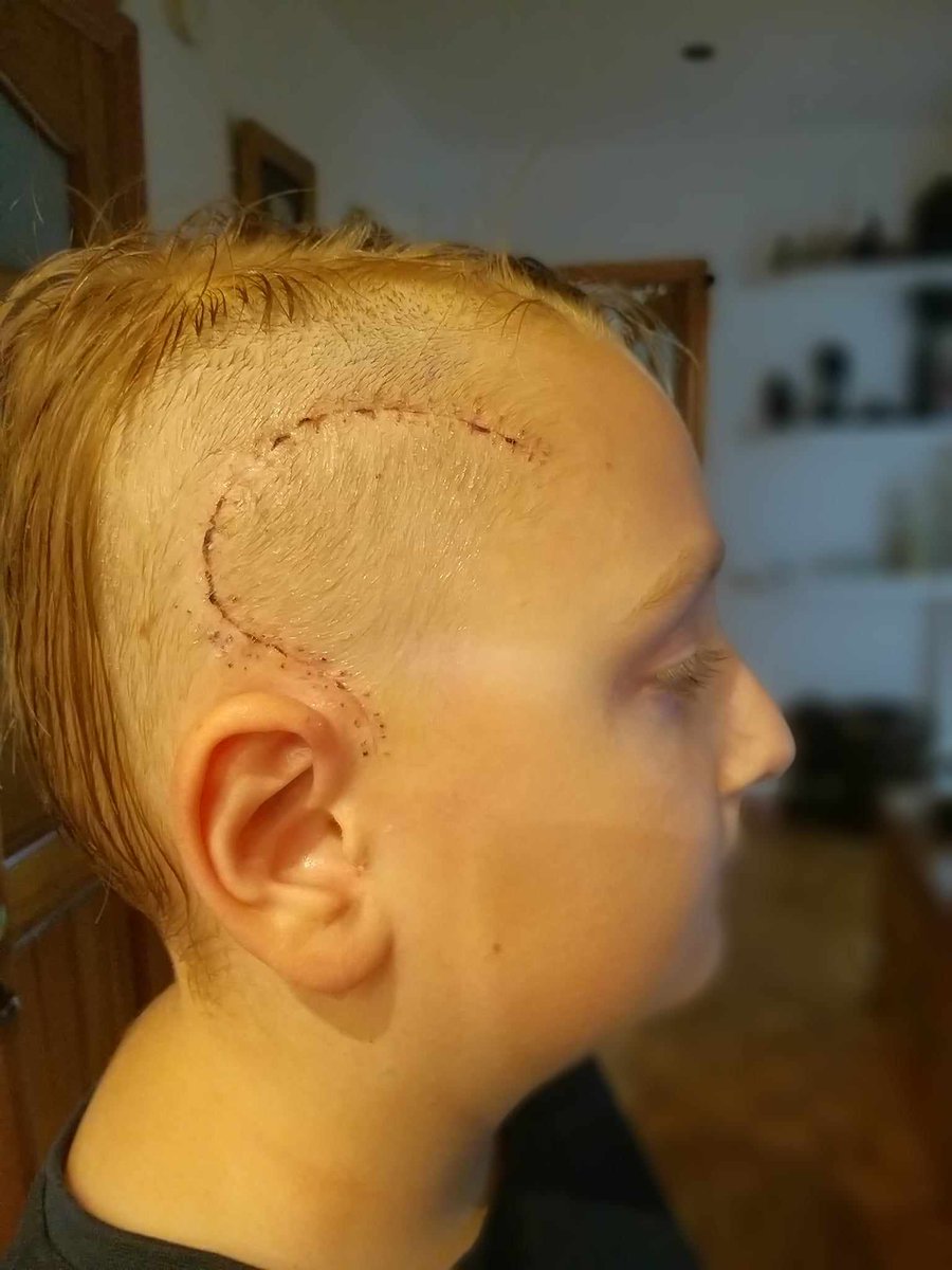damian_zurawski's tweet photo. Proszę o RT🙏

Samotna matka stara się desperacko ocalić życie swojego dziecka, które stoi w obliczu walki z glejakiem..💔
Proszę, jeśli wyświetlił Ci się ten post polub go i udostępnij, to nic nie kosztuje, a tylko w taki sposób będziemy mogli dać mu szansę na dalsze życie.

https://t.co/AHsOYmBDeE